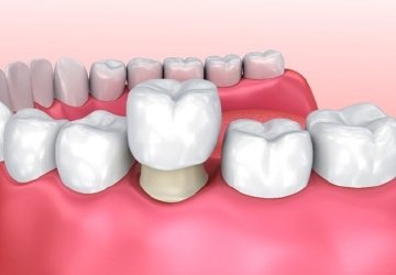 Animation of dental crown placement