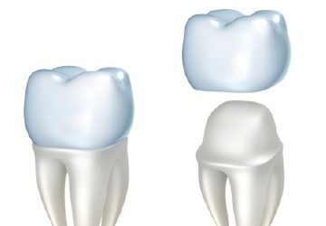 Animation of dental crown placement