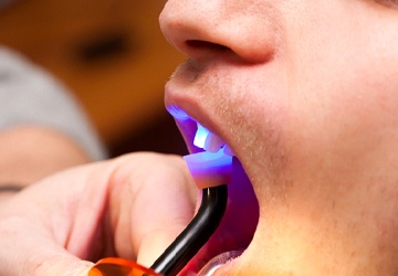 Man having dental bonding procedure