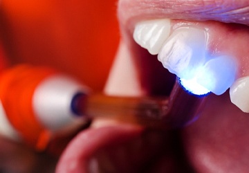 Dental bonding procedure