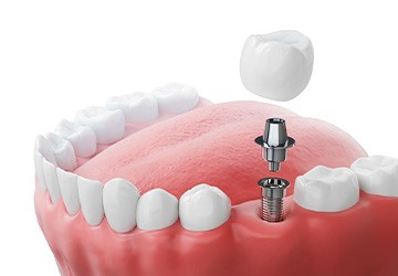 Dental implants are an alternative tooth replacement option to dentures