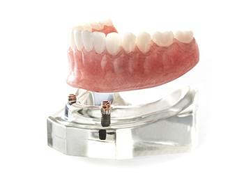 Implant dentures on smile model