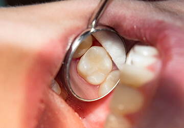 Close-up of dental mirror showing seamless tooth-colored filling