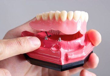 Implant denture model