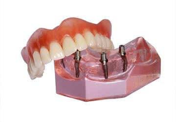 Model of implant retained denture