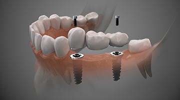 Diagram showing an implant bridge replacing multiple missing teeth in Melbourne