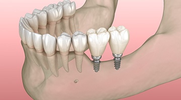 Diagram showing mini dental implants in Melbourne