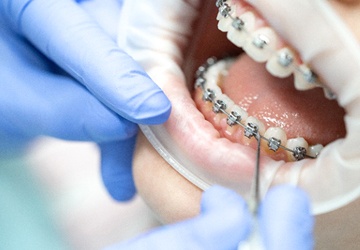 Dentist placing mental braces on patient's teeth