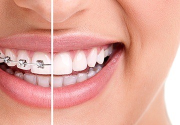 Closeup of smile half during and half after braces