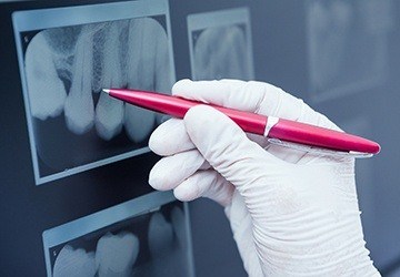 Pen pointing at dental x-rays