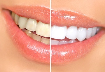 Teeth whitening