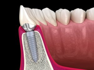 3-D diagram of a dental implant